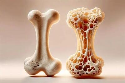  خوراکی‌هایی که استخوان‌ها را ضعیف می‌کنند بشناسید